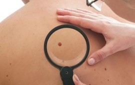 ד"ר לוי אברהם מסביר מדוע חשוב לאבחן ולהסיר שומות ונקודות חן חשודות