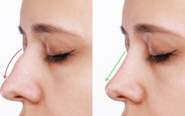 ניתוח אף - סוגי ניתוחים ותהליך ההחלמה | המידע המלא קרדיט תמונה FREEPIK