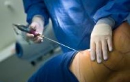 הצרת היקפים ללא ניתוח – כל מה שרצית לדעת!! הצרת היקפים